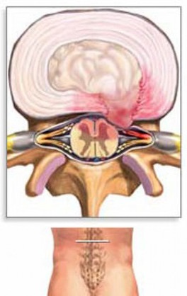 Ce este osteochondroza lombară periculoasă și cum să o tratezi