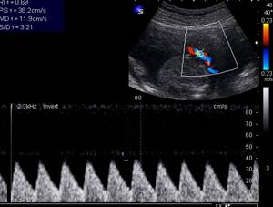 Doppler cu ultrasunete