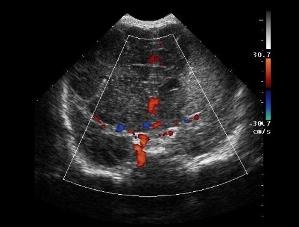 Doppler ultrahang