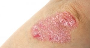 Eczemele cauzate de coate, simptome și tratament