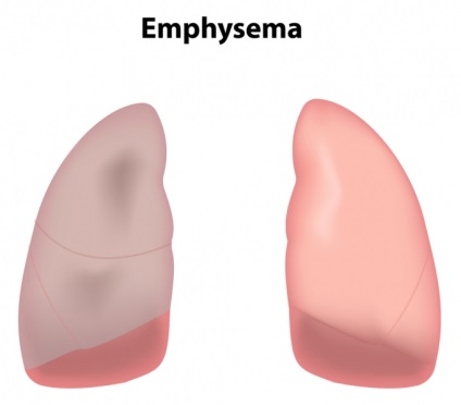 Emfizemul plămânilor, credibil cu privire la cauzele și prognosticul emfizemului pulmonar, vitaportal - sănătate și medicină