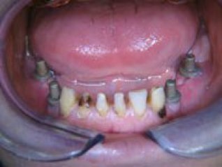 Implantarea endodonto-endozică, insidenta medicală