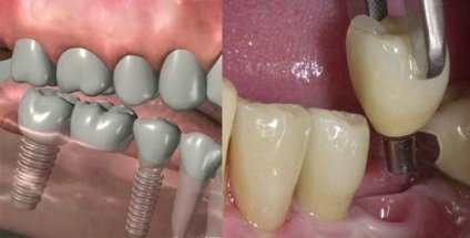 Implantarea endodonto-endozică, insidenta medicală