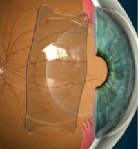 Imagini intraoculare lentile Phakic Revizuirea IOL a modelelor, recenziilor și prețurilor