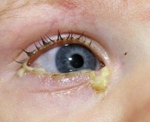 Ochii Gnoyatsya și un nas curbat în copil, ce să facă cu puroi din ochi cu o frig