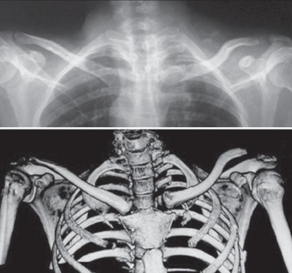 Structura articulațiilor mamare și claviculare