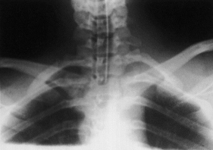 Structura articulațiilor mamare și claviculare