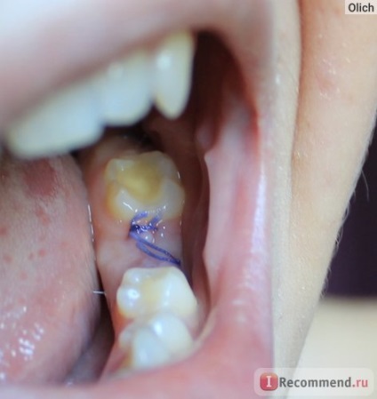 Implantarea dintelui - 