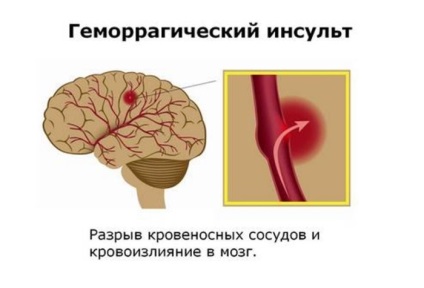 Accident vascular cerebral hemoragic și efecte secundare stângi și câți trăiesc