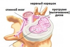 Cum sa masati cu proeminenta spinarii coloanei vertebrale, toracice si lombare