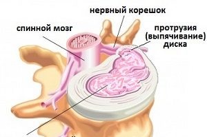 Hogyan masszírozza a gerinc kiemelkedés, a nyaki, háti és ágyéki gerinc