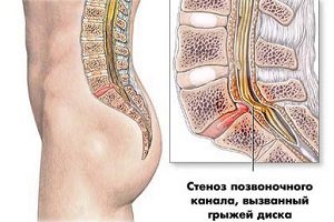 Cum este perioada postoperatorie după îndepărtarea herniilor coloanei vertebrale