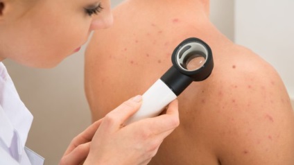 Cum să eliminați acneea pe spate la domiciliu, cauzele și tratamentul acneei și acneei