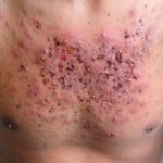 Mi psoriasis - hasonlóságok és különbségek betegségek - psoriasis kezelésére