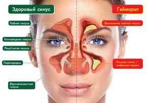 Hogyan lehet gyógyítani arcüreggyulladás - torok betegség - cikkek Directory - népi gyógyszer receptek