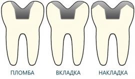 Cum de a restabili dinții sparte sau căzute, stomatologie - vitar - g