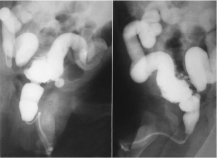 Supape ale simptomelor uretrei posterioare, semne, diagnostic și tratament