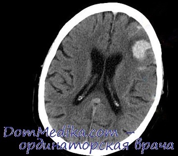 Clinica, diagnosticul de metastaze ale tumorilor din creier