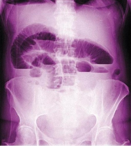 Când și de ce am nevoie de o radiografie a intestinului