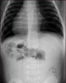 Când și de ce am nevoie de o radiografie a intestinului