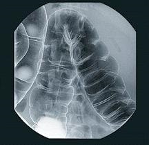 Când și de ce am nevoie de o radiografie a intestinului