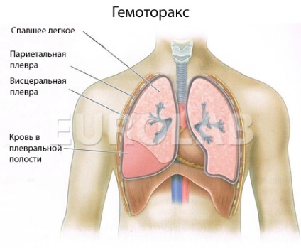 Tratamentul hemotoraxului pulmonar - portal medical eurolab