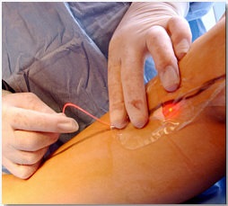 Tratamentul venelor varicoase cu un laser