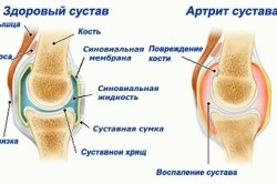 Lfk cu artrită reumatoidă
