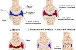 Exercise terápia rheumatoid arthritis