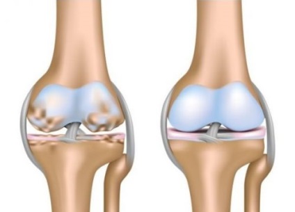 Bile medicale cu artroză articulației genunchiului