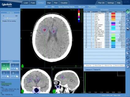 Metastaze în tratamentul creierului, diagnostic, simptome - clinica spizko