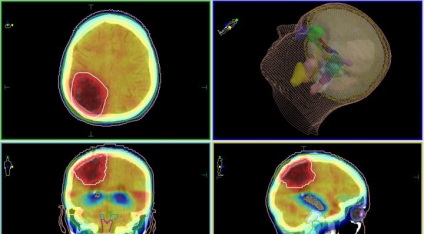 Metastaze în tratamentul creierului, diagnostic, simptome - clinica spizko