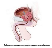 Microclysters prostatitis készítmények hatással rendelkeznek, különösen az eljárás