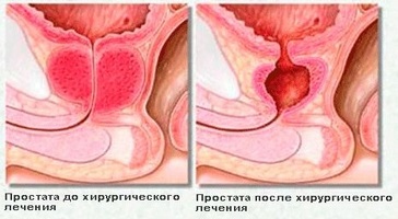 Microcliști cu compoziții de prostatită, acțiune, trăsături ale procedurii