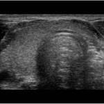 Myxedema provoacă, simptome și tratament