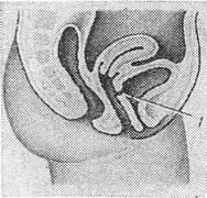 Genitourinary fistula la femei