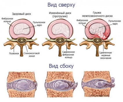 Este posibil sa faci un masaj cu proeminenta coloanei vertebrale