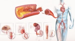 Este posibilă vindecarea osteocondrozei complet și permanent?