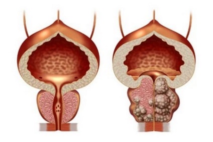 Starea de simetrie pentru vindecarea adenomului de prostată este adevărată sau fraudă