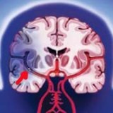 Neuroprotectori în tratamentul accident vascular cerebral ischemic - bisturiu - medical