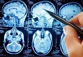 Neuroprotectori în tratamentul bolilor creierului