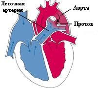 OAP sau canalul arterial deschis la copii, cauzele oupelor la copii, simptomele deschise