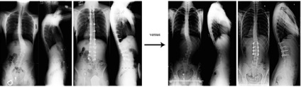 Chirurgie pentru scolioza