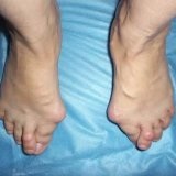 Panouri ortopedice cu picioare plate