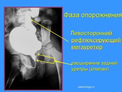 Departamentul de Urologie Pediatrica, Andrologie si Chirurgie Routina dgkb №13 ova - supapa uretrei posterioare