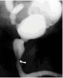 Departamentul de Urologie Pediatrica, Andrologie si Chirurgie Routina dgkb №13 ova - supapa uretrei posterioare