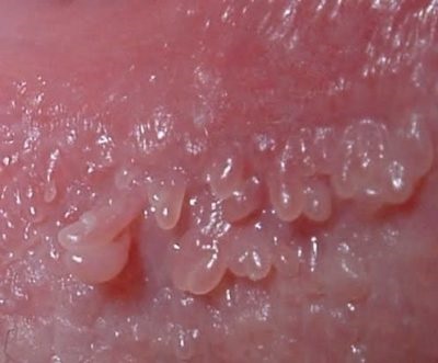 Papillomavírus genitális ajkak néz ki, és hogyan kell eltávolítani a nők