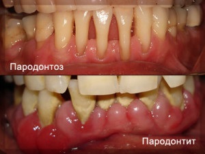 Пародонтоза и пародонтит - каква е разликата между снимка и лекарства за лечение на