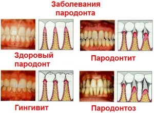 Parodontoza și parodontita - care este diferența dintre fotografie și medicamente pentru tratament?