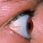 Gout-eyed - de ce se întâmplă, metode de diagnostic și tratament